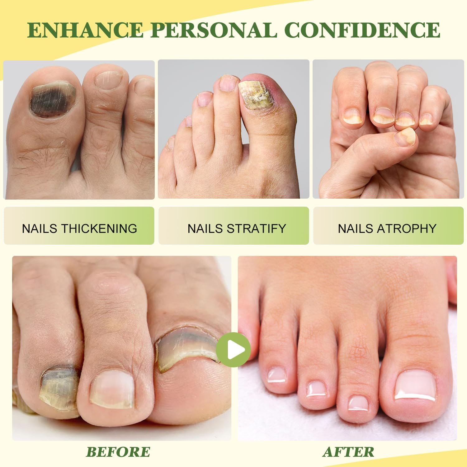 Nail Defense Bee Venom Treatment Serum, Nail Growth and Repair Serum, Foot Care Soothing Serum for Athletes Foot, Thick Toe Care, Nail Strengthener Cuticle Serum(15ml/2pcs) - Image 8