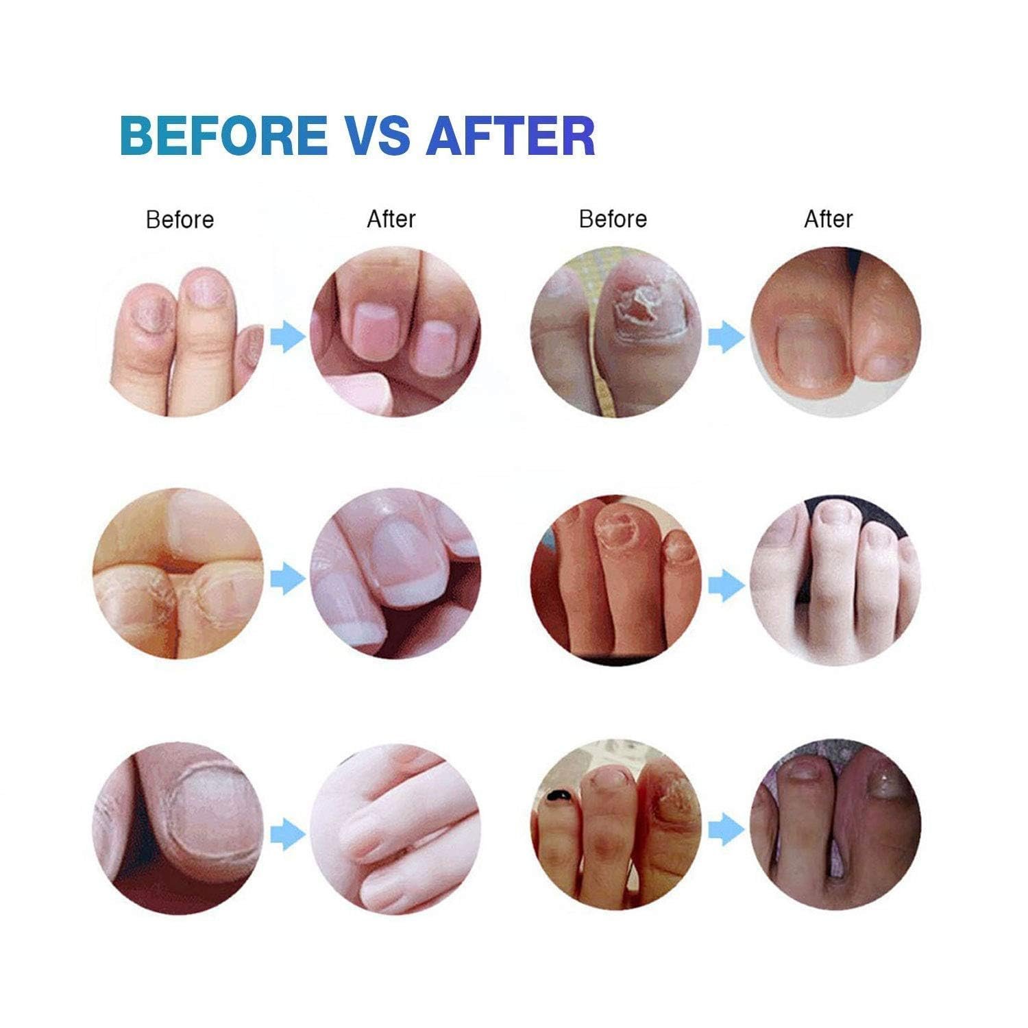 Toenail Fungus Treatment Extra Strength: Nail Fungus Treatment for Toenail - Fungal Nail Repair Pen 4 Packs - Image 5