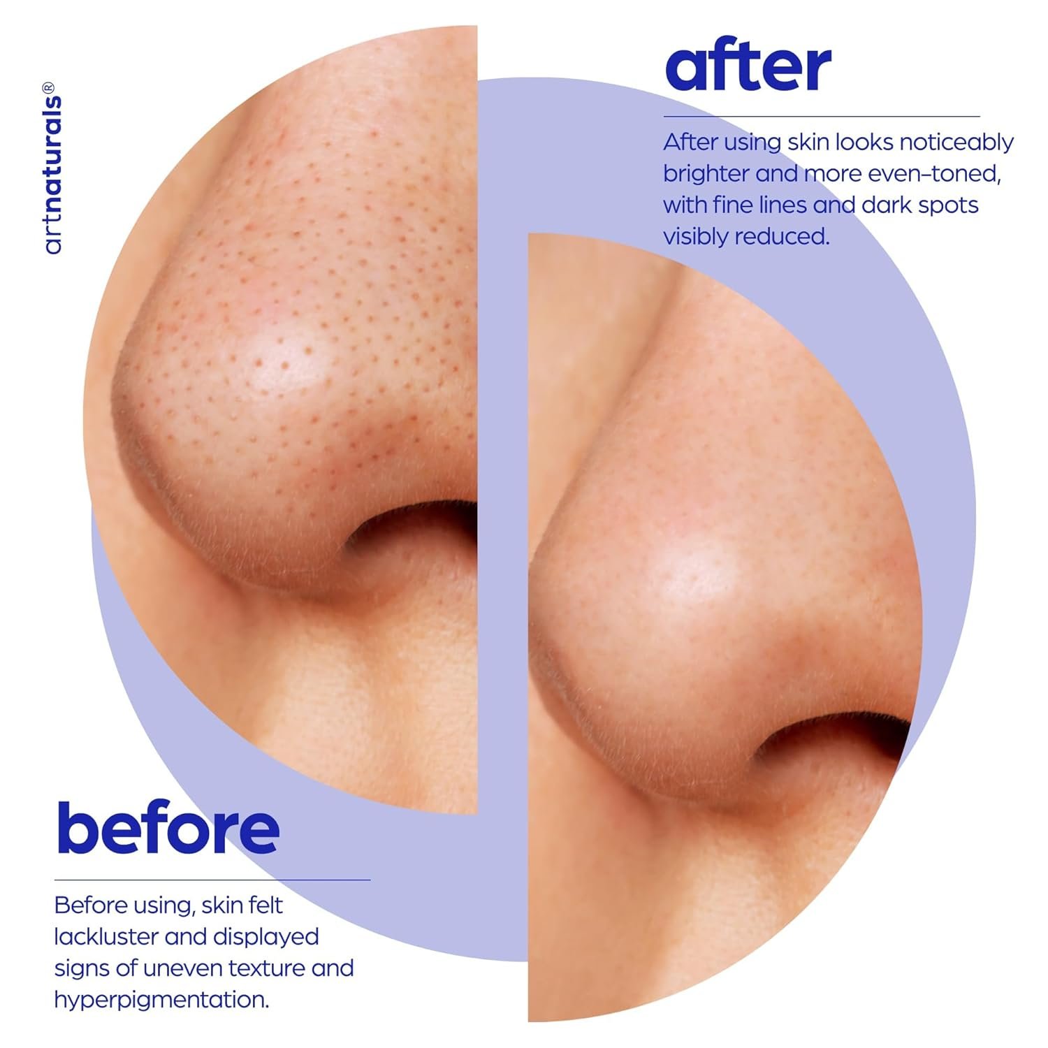 artnaturals Glycolic Serum - Face Serum - Vitamin C and Aloe Vera - Exfoliates and Minimizes Pores, Reduce Acne, Breakouts, and Appearance of Aging and Scars -1 oz. - Image 7