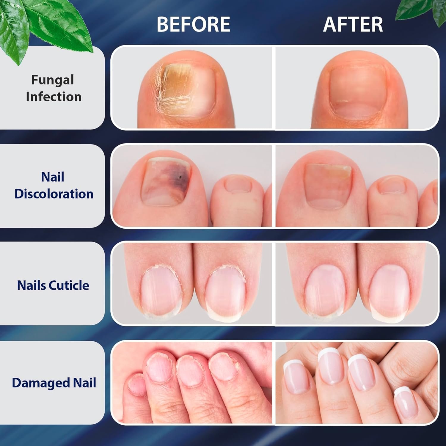 Toenail Fungus Treatment Extra Strength, Nail Fungus Treatment for Toenail, Fungus Nail Treatment, Nail Fungus Treatment for Fingernails (1oz) - Image 5