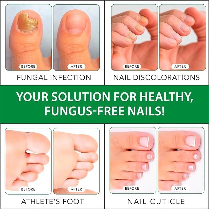 Viking Revolution Toenail Fungus Treatment Extra Strength with 1% Tolnaftate OTC - Nail Fungus Treatment for Toenail Tea Tree Oil Fungus Nail Treatment - Athletes Foot Toe Fungus Treatment Oregano Oil - Image 3