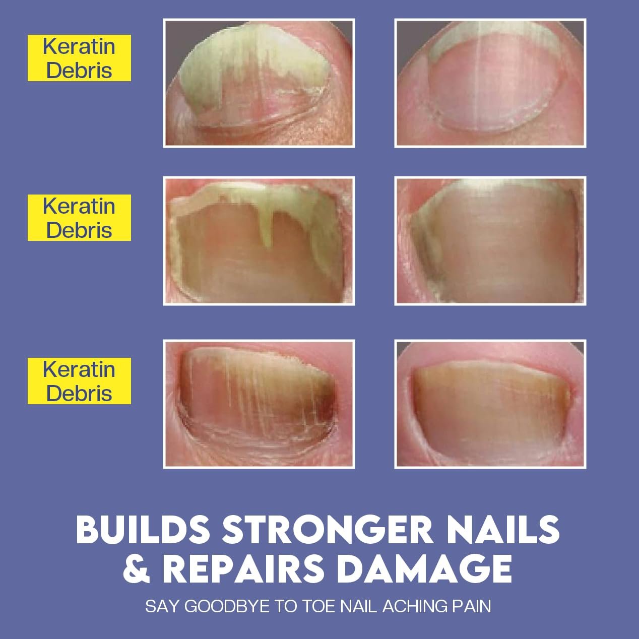 Toenail Treatment -Extra Strength Nail Treatment - Nail Repair Pen for Nail Discoloration Nails - 4PCS - Image 6