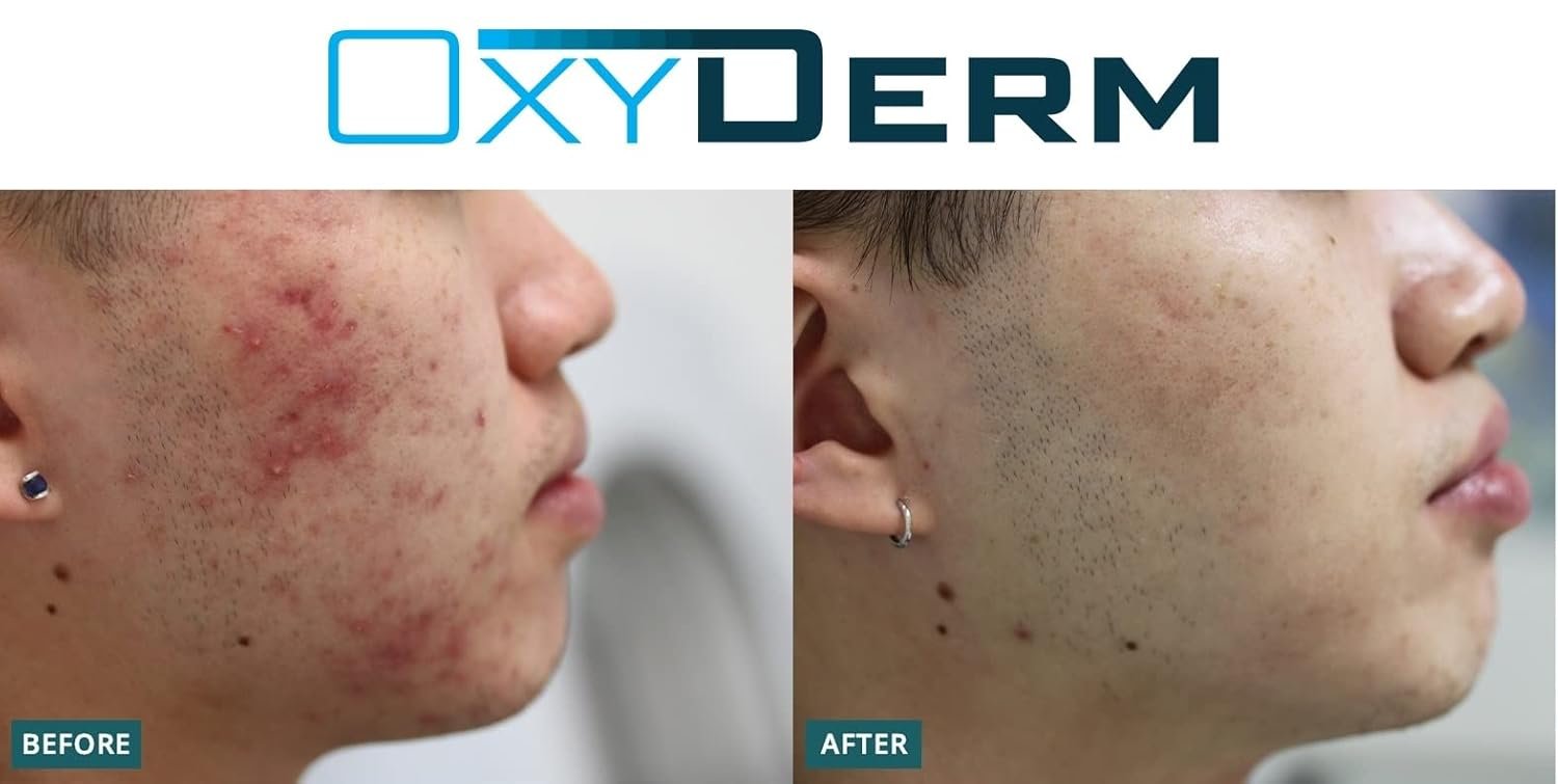 Acne Clearing Treatment Pads- Eliminates Acne Breakout Causing Bacteria. Clear Away Clogged Pores, Oily Skin, Blemish, Blackhead, Pimple, Cystic Breakouts. Contains Salicylic, Glycolic & Lactic Acid. - Image 7