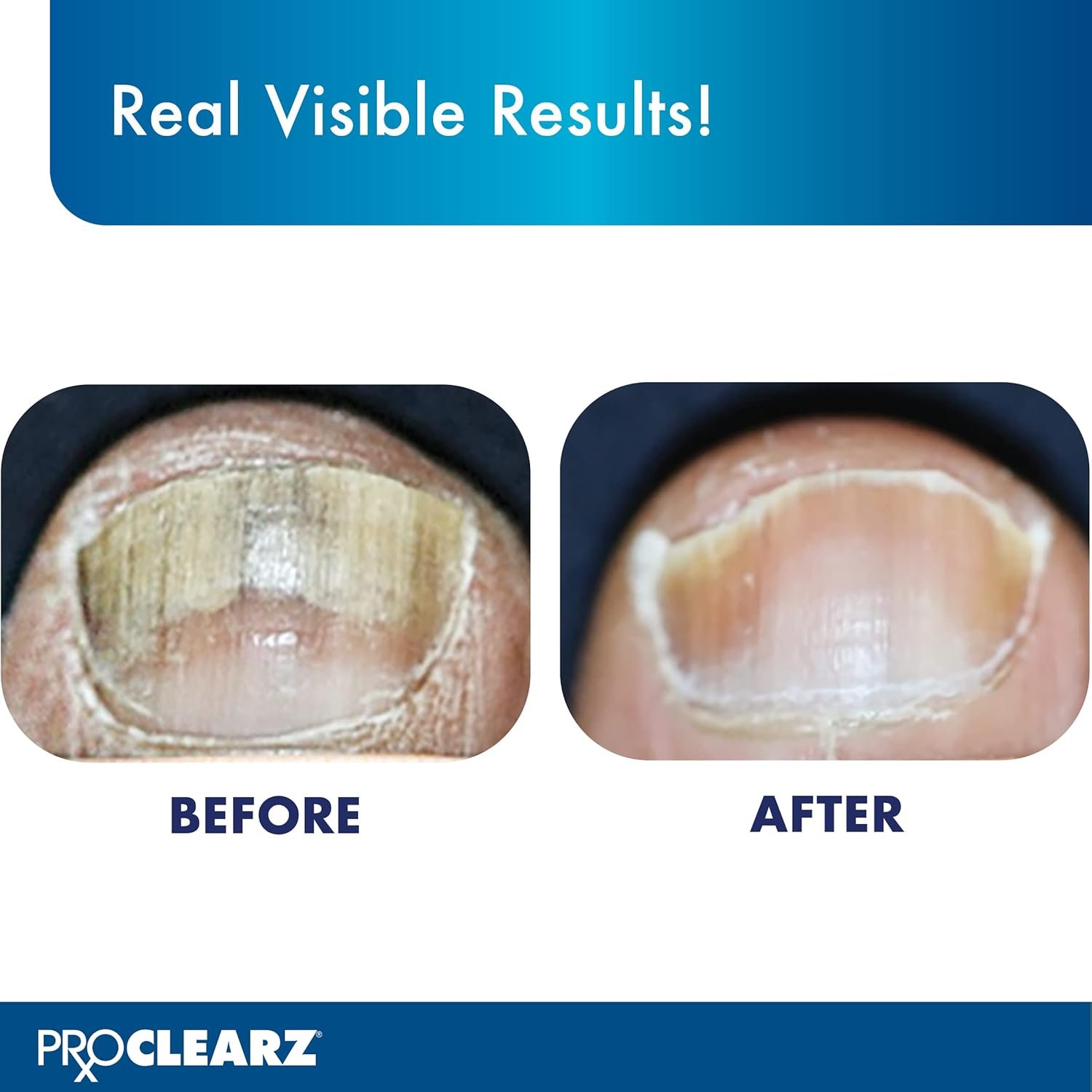 Brite Now Nail Treatment, Restores The Appearance Of Damaged & Discolored Nails, Peel-Away Technology, Brightening & Smoothing Nail Repair, 0.5 Ounce - Image 6