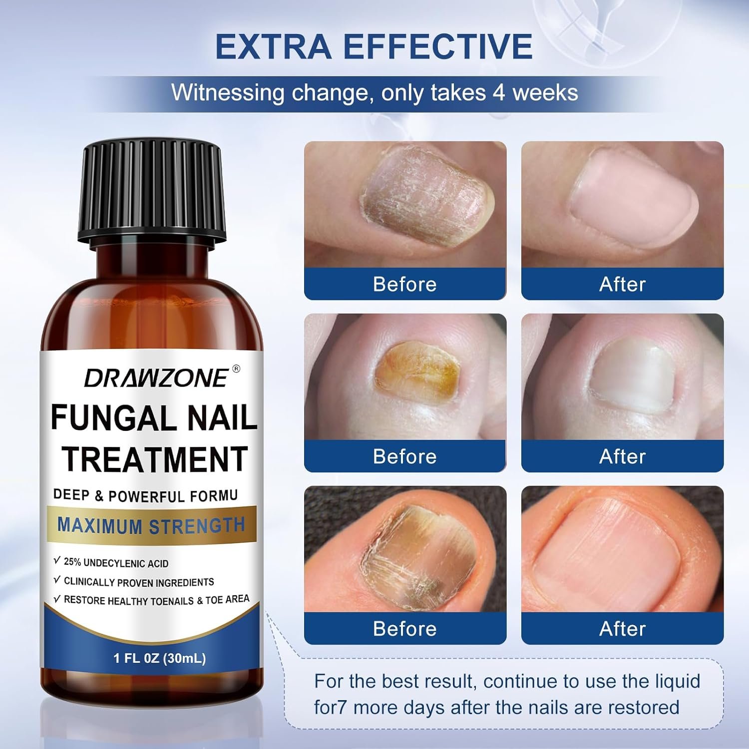 Toenail Fungus Treatment Extra Strength with 25% Undecylenic Acid, Ingrown toenail treatment, nail repair, Fungus nail treatment, yellow toenail, Damaged Nails foot fungus treatment extra strength - Image 5