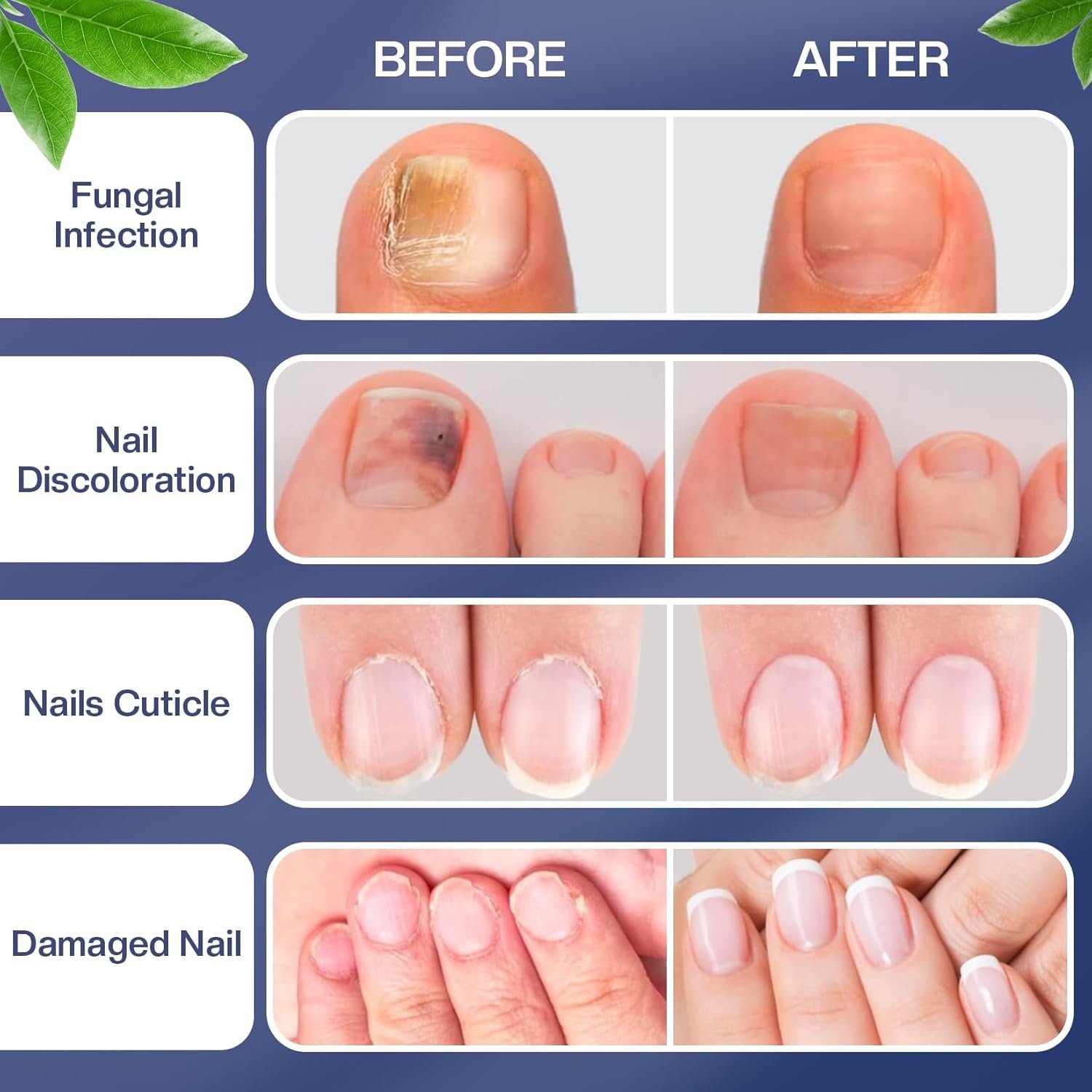 Toenail Treatment -Extra Strength Nail Treatment - Nail Repair Pen for Nail Discoloration Nails - 4PCS - Image 5