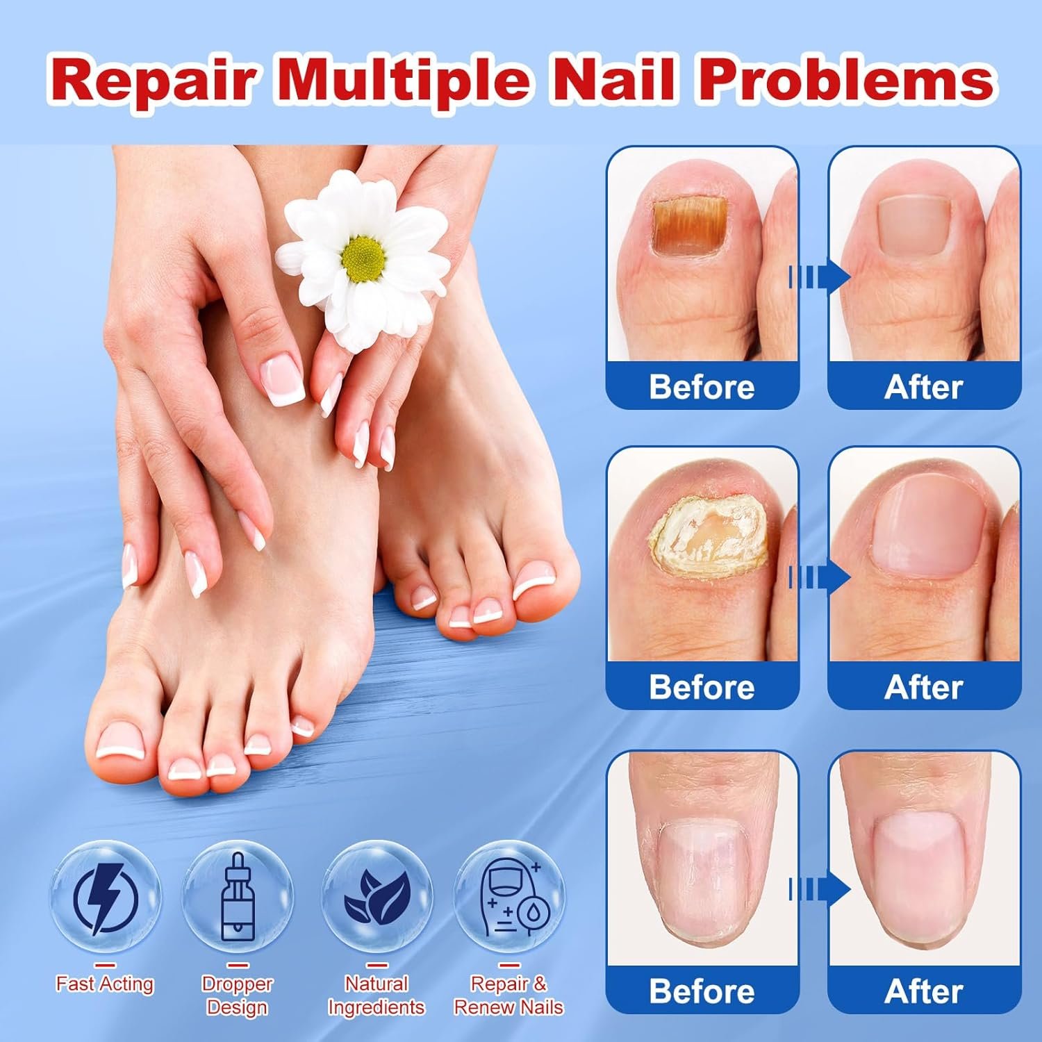 Toenail Fungus Treatment, Extra Strength Nail Fungus Remover, Toe Fingernail Repair Liquid Solution Fast Acting for Woman and Man - 30mL(1 fl oz) - Image 7