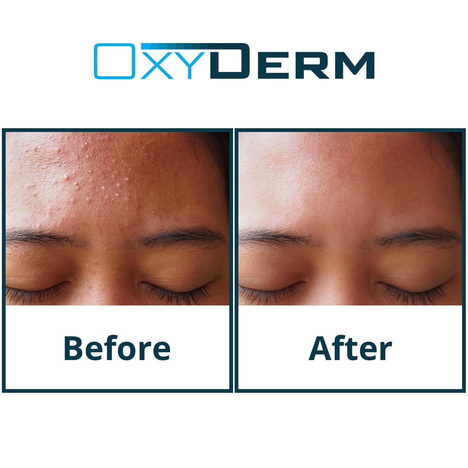 Acne Clearing Treatment Pads- Eliminates Acne Breakout Causing Bacteria. Clear Away Clogged Pores, Oily Skin, Blemish, Blackhead, Pimple, Cystic Breakouts. Contains Salicylic, Glycolic & Lactic Acid. - Image 4