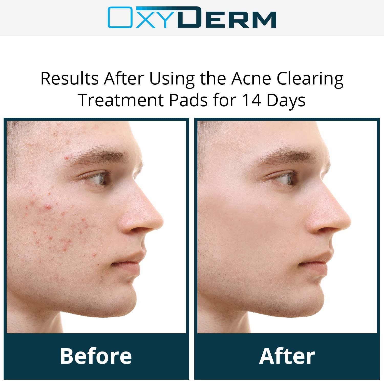 Acne Clearing Treatment Pads- Eliminates Acne Breakout Causing Bacteria. Clear Away Clogged Pores, Oily Skin, Blemish, Blackhead, Pimple, Cystic Breakouts. Contains Salicylic, Glycolic & Lactic Acid. - Image 6