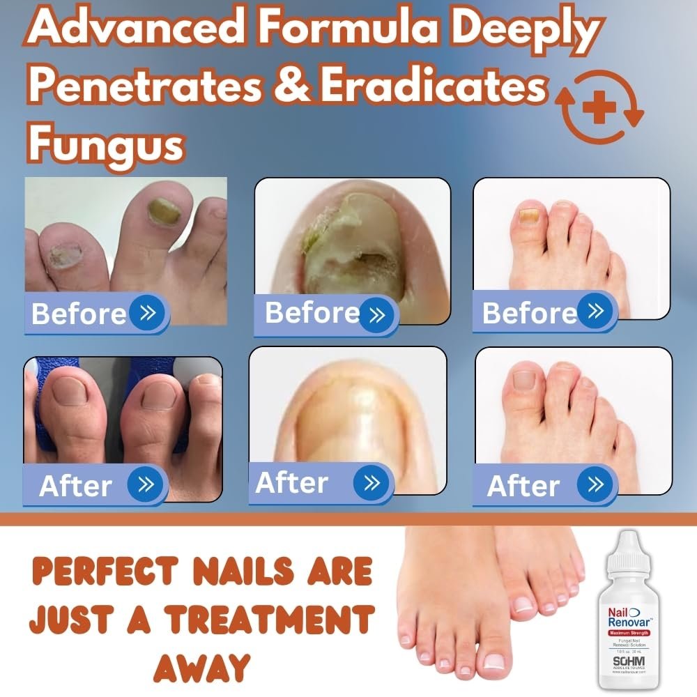 Toenail Fungus Treatment Extra Strength - FDA-Compliant,Made In USA-Toe Nail Fungus Treatments, Discolored or Brittle Nails -Nail Care Fl Oz 1.0 (30 ml) - Image 3