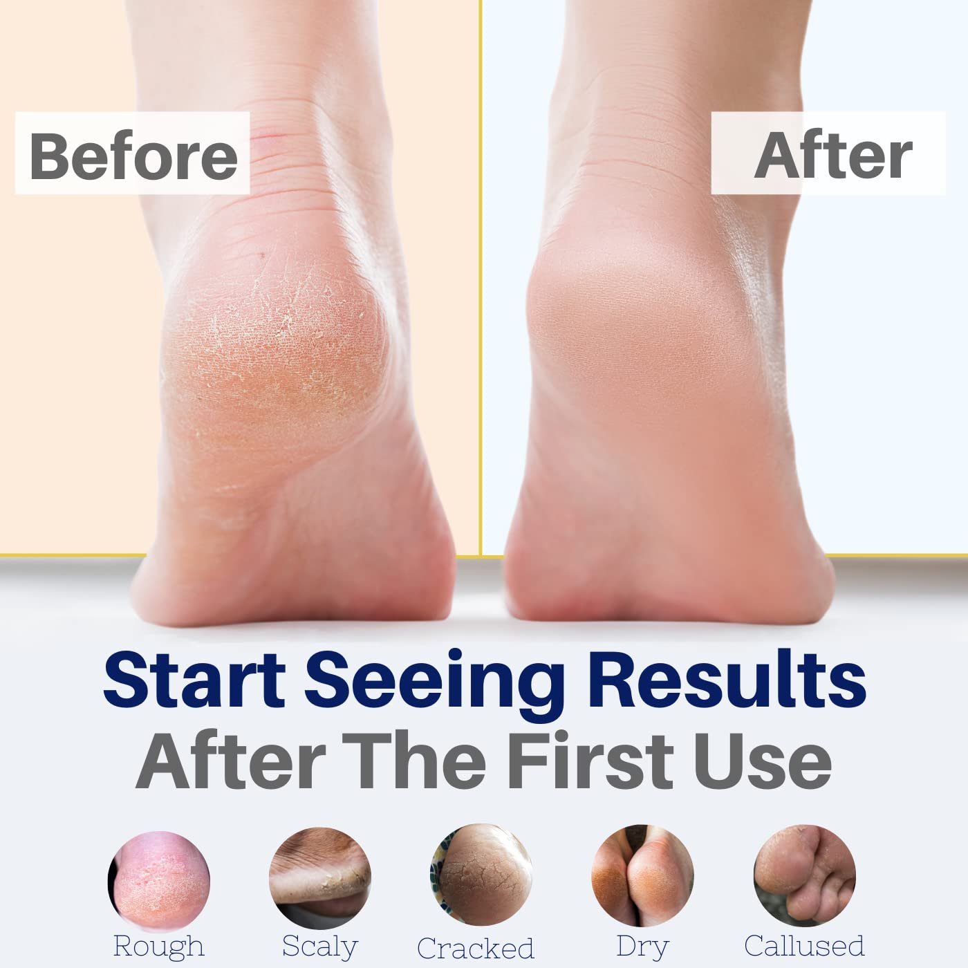 Yellow Bird Natural Foot Cream - For Dry and Cracked Feet Repair. Organic Athlete’s Foot Balm. Salve Moisturizer for Heel Care & Callus Treatment with Tea Tree Oil & Peppermint Essential Oils - Image 3