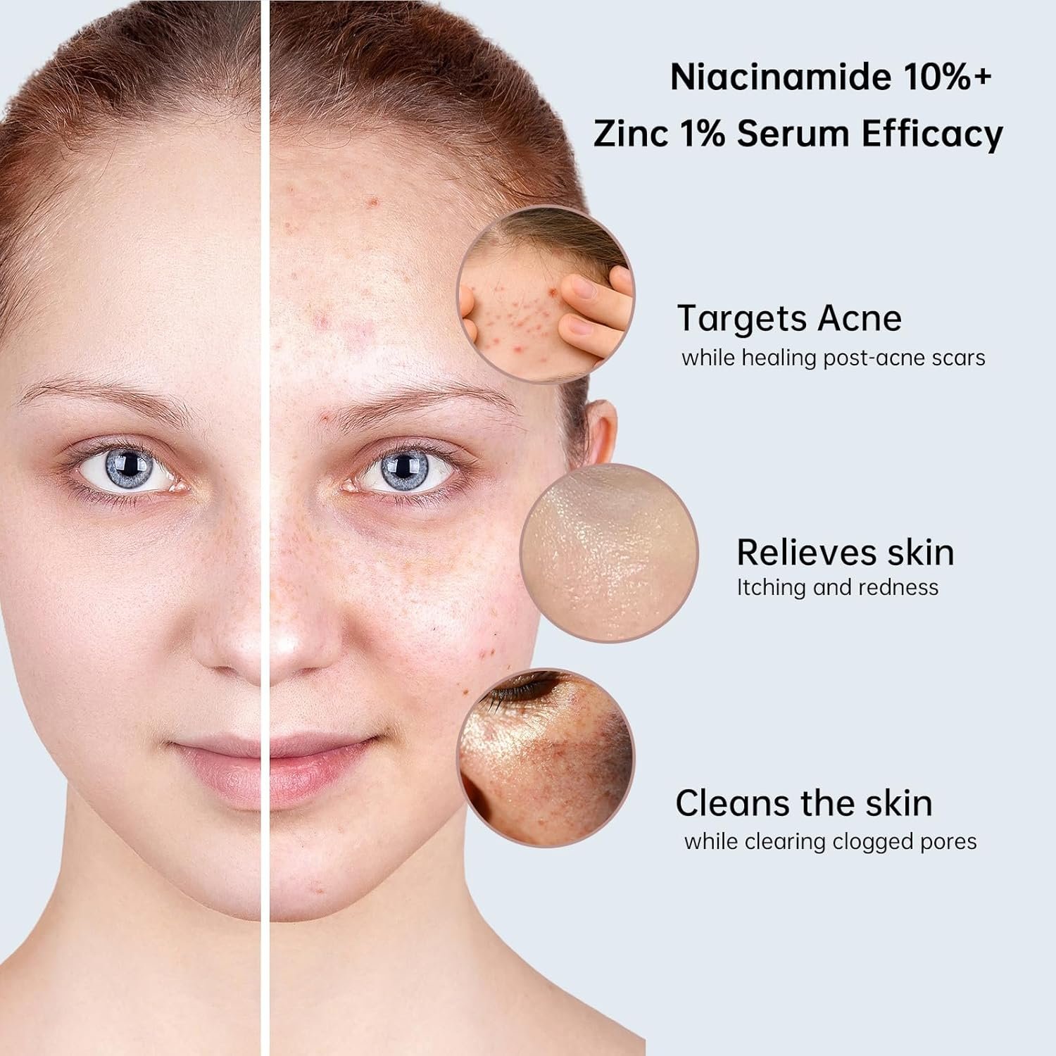 Niacinamide 10%+ Zinc 1% Serum For Face, Niacinamide Serum For Face, Dermatologist, Redness Relieve-30ml 1floz - Image 7