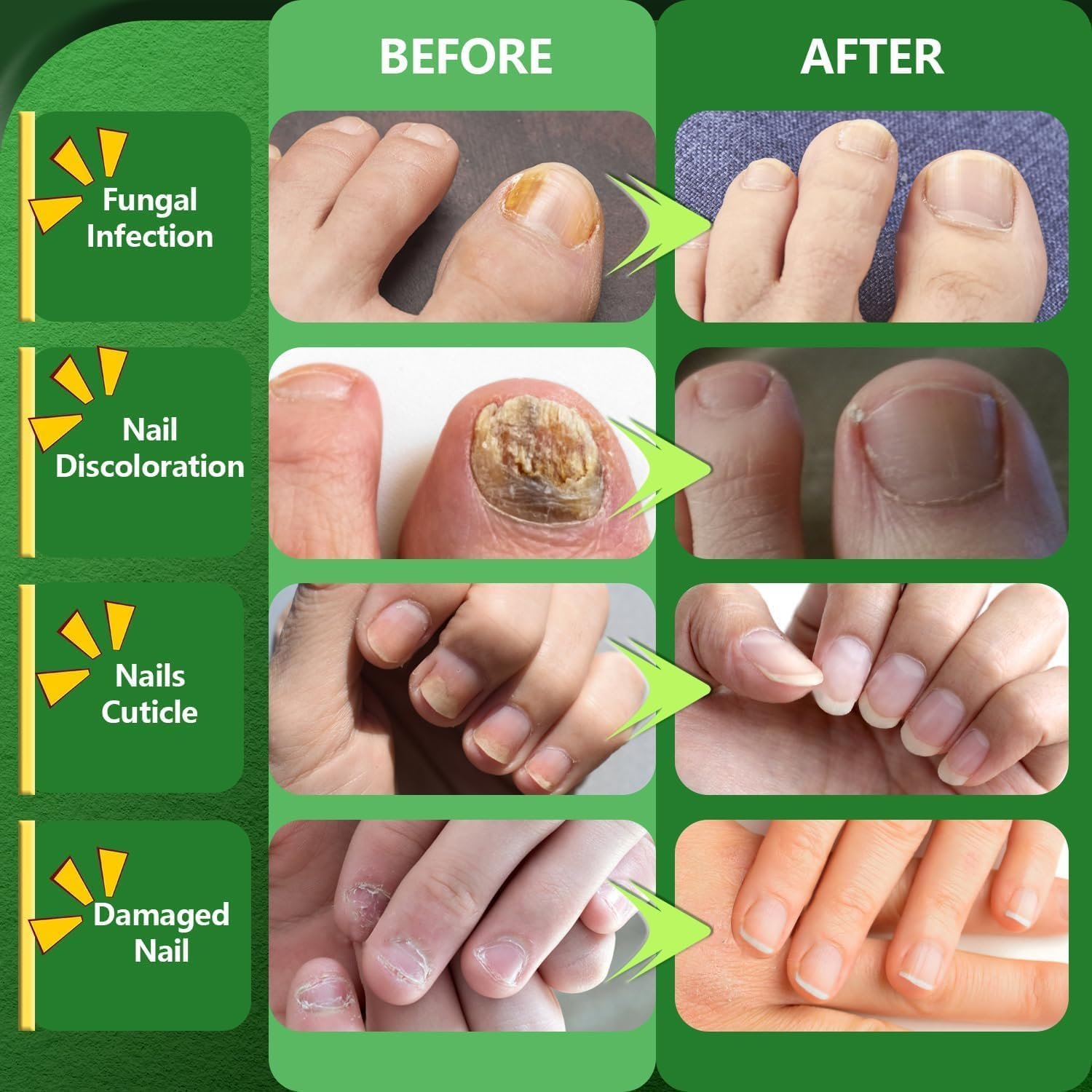 Toenail Fungus Treatment Extra Strength, Nail Fungus Treatments for Toenail With Naturally And Safely, Toenail Fungus Treatment Extra Strength For Athletes Foot, Thick, Broken - Image 6