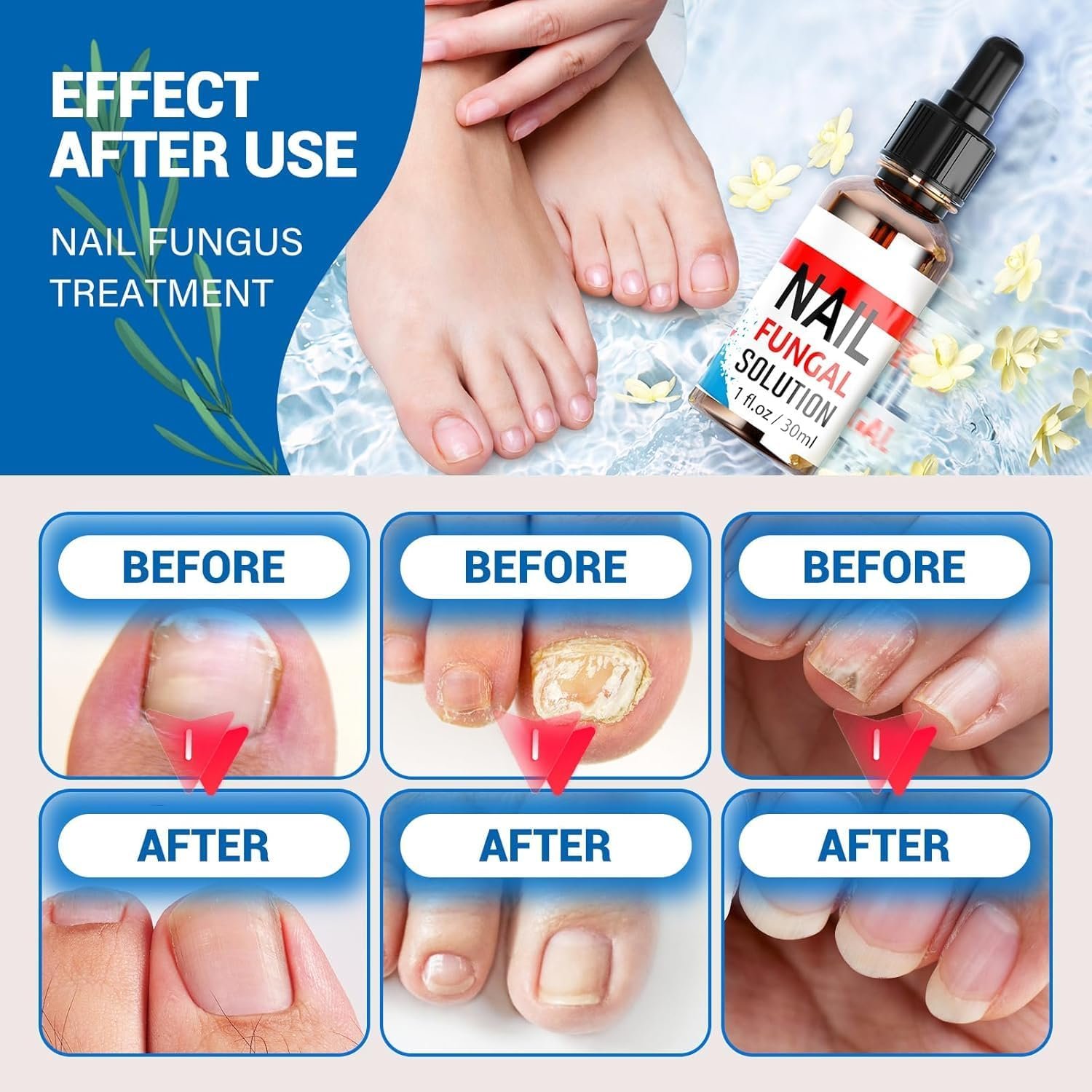 Toenail Fungus Treatment, Toe Nail Fungus Treatment for Toenail & Fingernails, Extra Strength Effective Enhancing Nail Repair for Finger & Toenail Safely & Gently Nail Repair, Toenail Softener -30ML - Image 6
