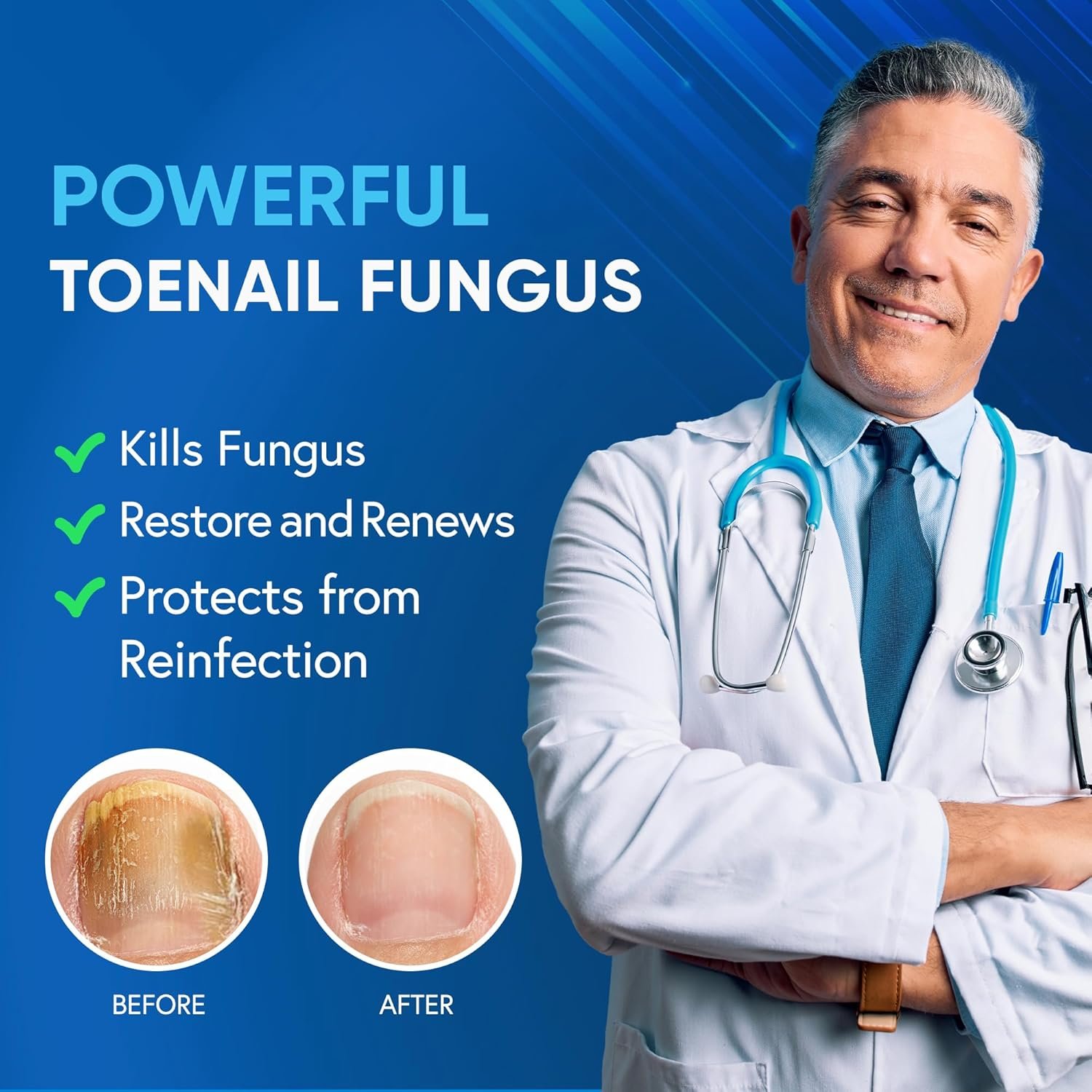 Toenail Fungus Treatment Extra Strength with 25% Undecylenic Acid & Tea Tree Oil, Nail Fungus Treatment for Toenail & Fingernails, Antifungal Nail Treatment for Damaged Nails and Thick Toenails- 2Pcs - Image 3
