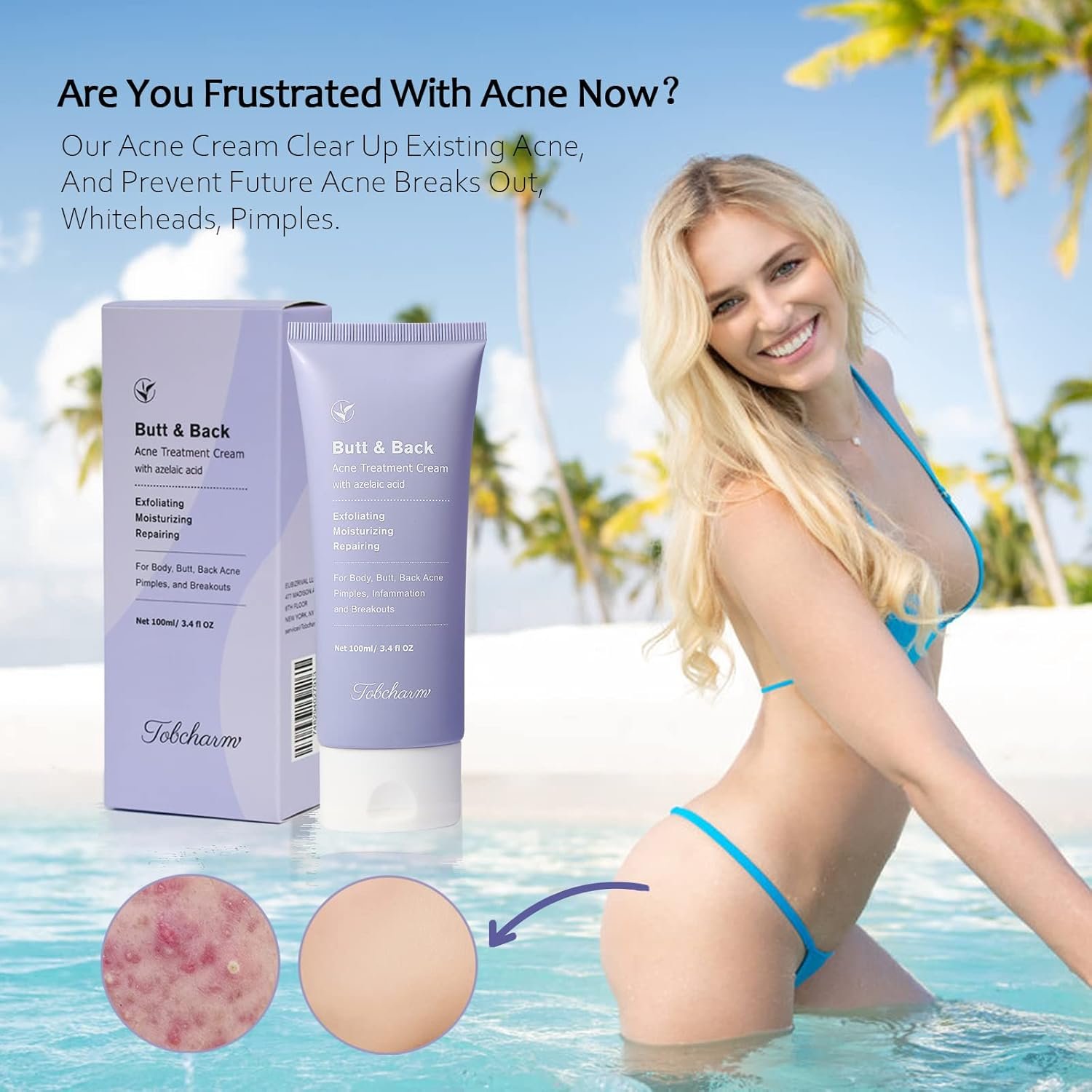 Butt Acne Clearing Treatment, Maximum Strength Body Cream for Back, Buttocks, Thigh & Chest Acne Removal, Skin Clearing Lotion for Men & Women, Foaming Cleanser for Bacne & Cystic Acne - Image 3