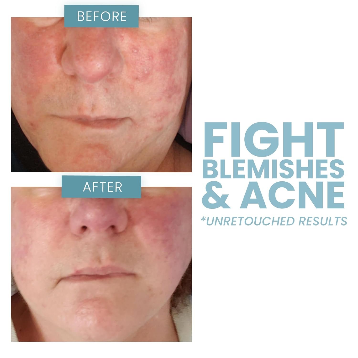 Vitamin C Serum 20% For Face, Pure Vitamin C Face Serum for Wrinkles, Acne, Dry Skin, and Dark Spots - Facial Vitamin C Serum (1oz) - Image 7