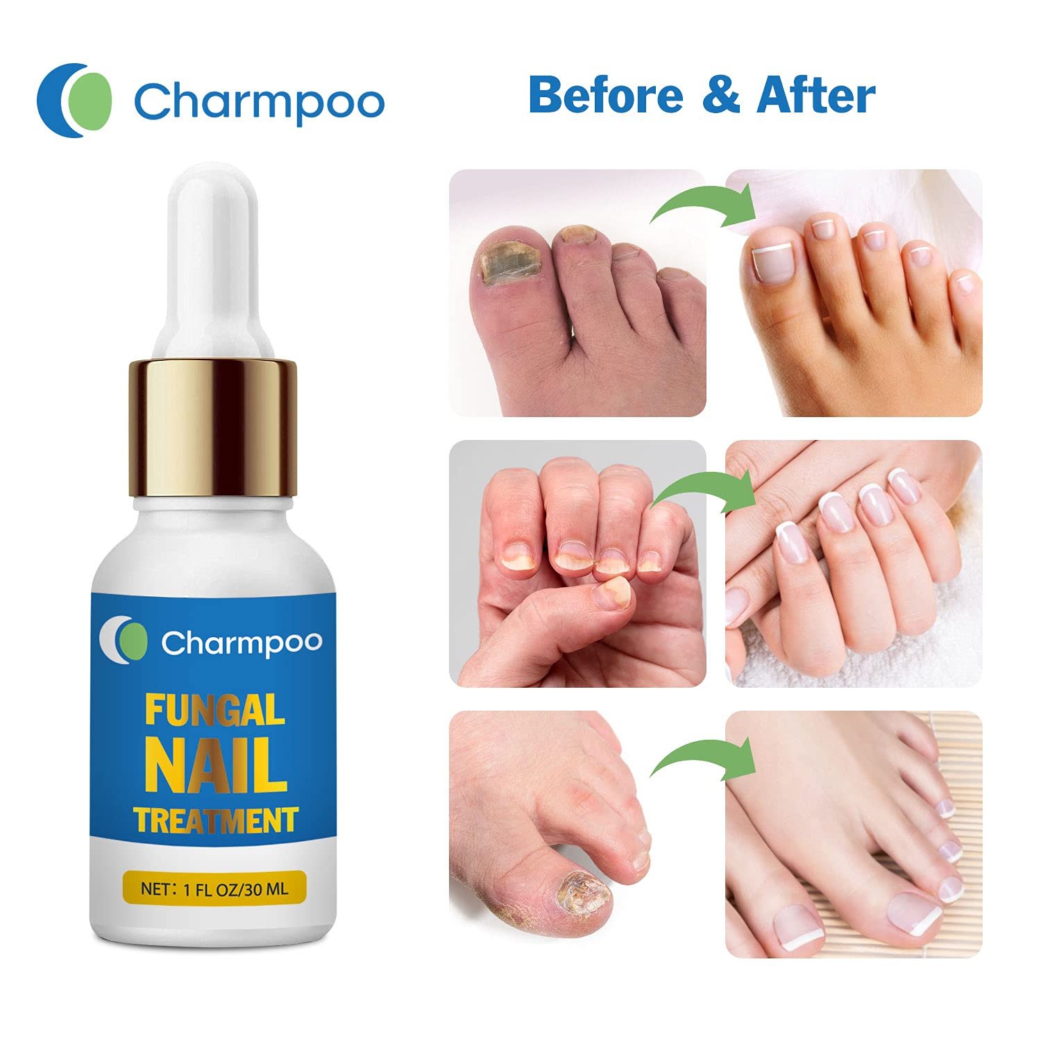 Charmpoo Fungus Nail Treatment for Toenail: Toenail Fungus Treatment Extra Strength - Toe Nail Antifungal Treatment Maximum Strength - Effective Fungal Nail Treatment for Fingernail&Toenail - Image 6
