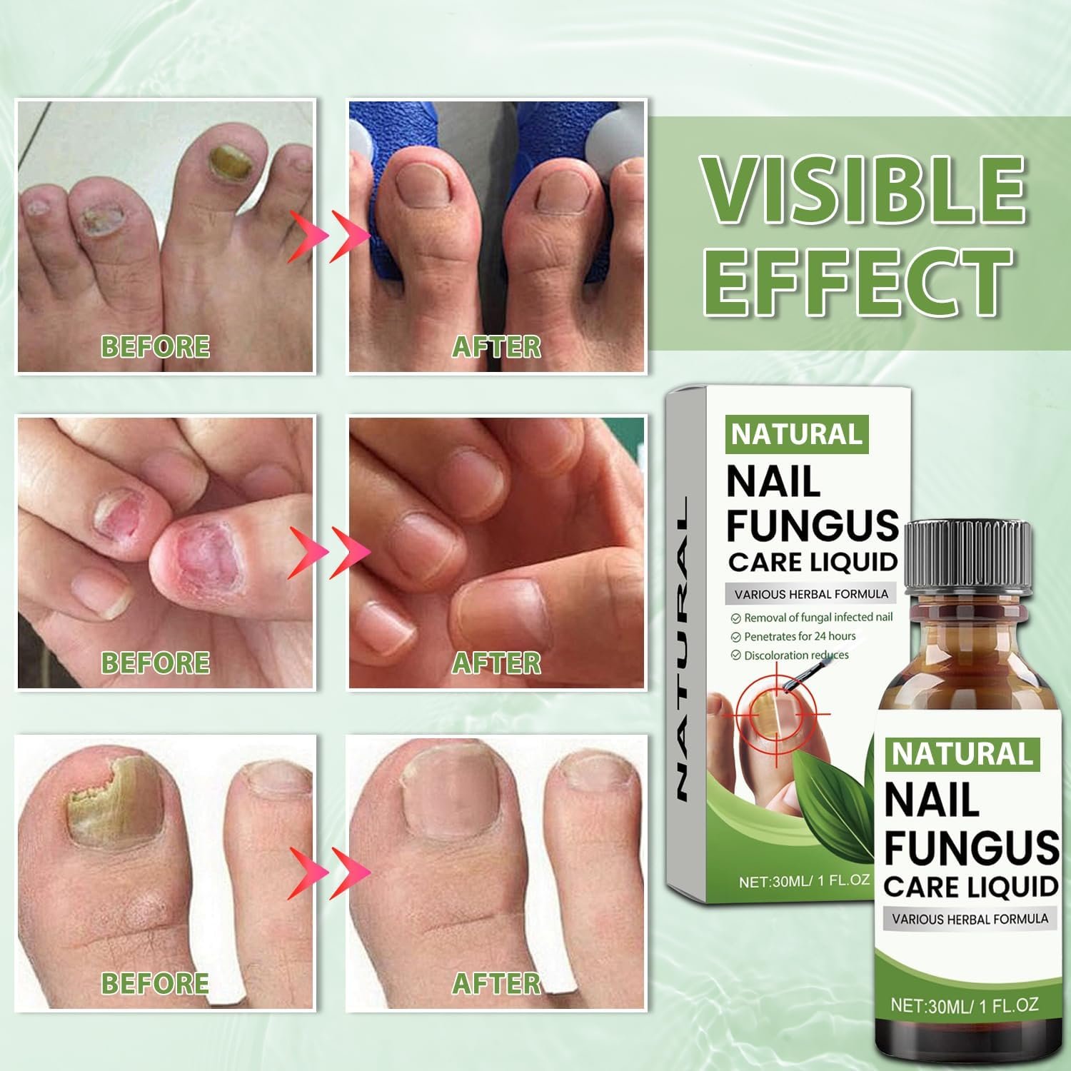 Toenail Fungus Treatment Extra Strength, Nail Fungus Treatment Extra Strength for Thick Nails, Broken, Discolored and Athlete's Foot, Fungus Nail Treatment Soft Brush Head Escalate, Green(30ML) - Image 7