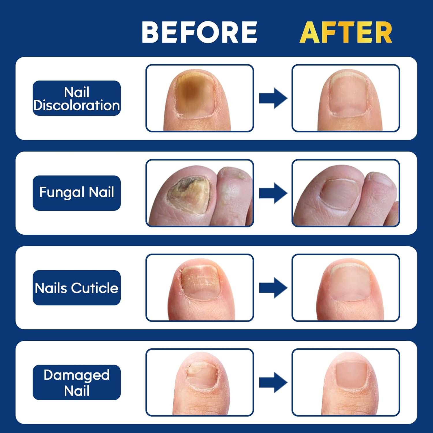 Toenail Repair Treatment Extra Strength with 32pcs Nail Repair Patches, Nail Repair Solution for Toenail & Fingernail, Nail Repair Treatment for Athletes Foot, Thick, Discolored, Damaged Nails - Image 4