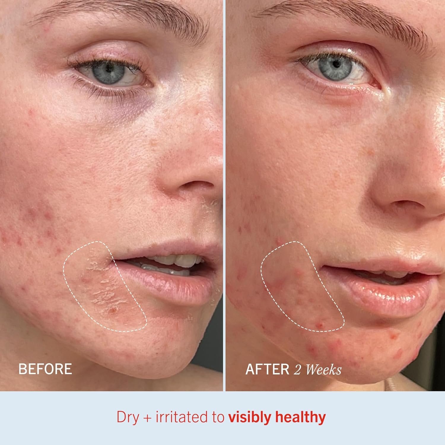 First Aid Beauty - Ultra Repair Cream, Intense Hydration Whipped Colloidal Oatmeal, Clinically Proven to Strengthen Skin Barrier in 7 Days & Helps Relieve Eczema, Luxury Moisturizer, 6 oz + Bonus, 2ct - Image 6