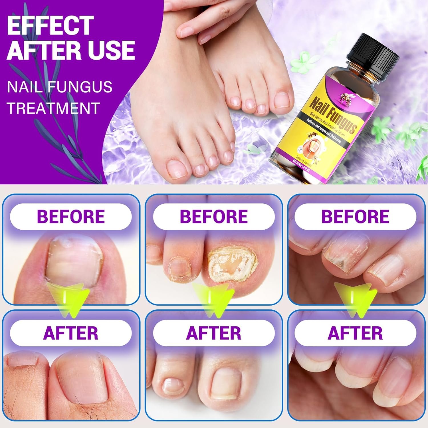 Toenail Fungus Treatment Extra Strength, Toe Nail Fungus Treatment with Naturally & Safely, Nail Fungus Treatments for Toenail Extra Strength for Thick, Broken, Discolored & Damaged Nail - Image 6