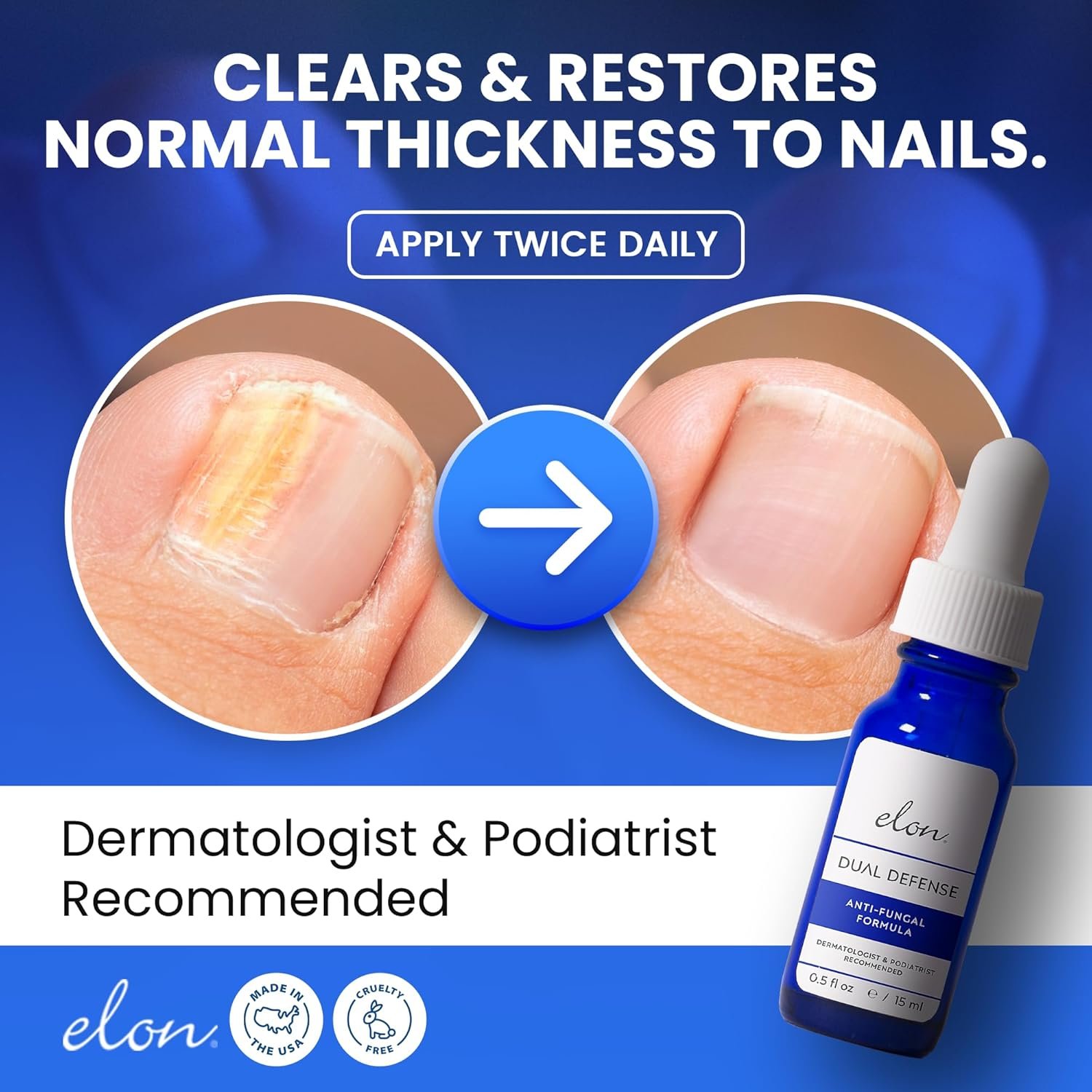 Elon Dual Defense Anti-Fungal Formula | 25% Undecylenic Acid | Treat & Eliminate Nail Fungus | Dermatologist & Podiatrist Recommended - Image 3