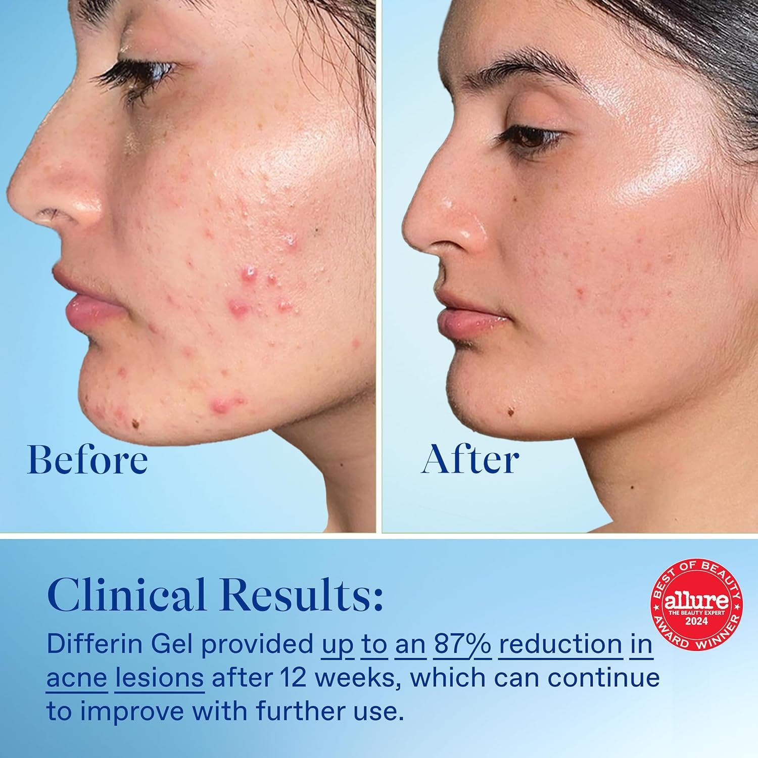 Differin Acne Treatment Gel, 90 Day Supply, Retinoid Treatment for Face with 0.1% Adapalene, Gentle Skin Care for Acne Prone Sensitive Skin, 45g Pump (Packaging May Vary) - Image 8